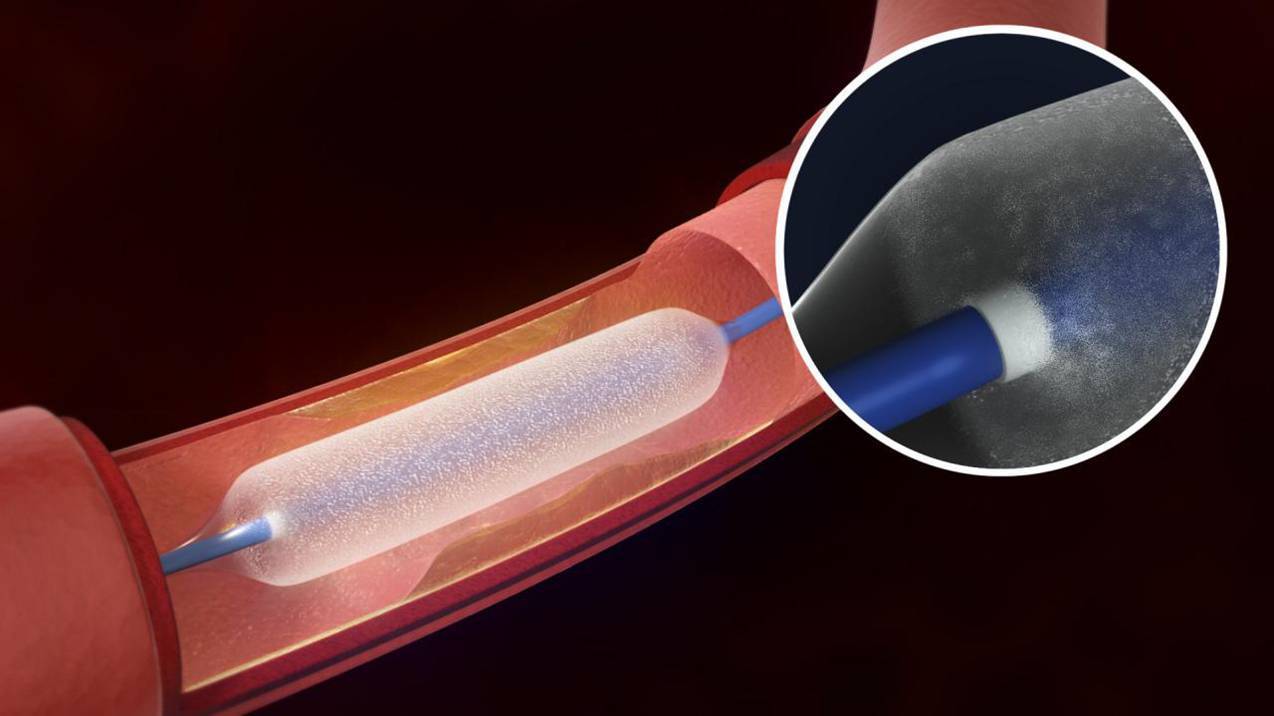 FDA Approves Six-Month Primary End Point for Lutonix Below-the